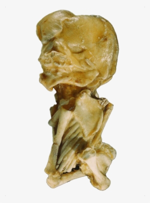 One Of The Best Qualities Of The People In The Trees - Lithopedion #4107434