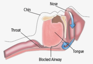 It May Be A Symptom Of A More Serious Sleep Disorder - Obstructive Sleep Apnea #4109088