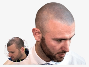 "i Love Having My Hair Back And Not Having To Use Hair-loss - Scalp Micropigmentation Filler #4153606