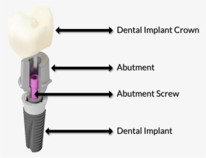 What Is The Difference Between A Dental Crown And A - Fixture Screw Abutment Crown #4173918