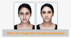 What Is Tear Trough Dark Circle Removal Procedure - Dark Circle Eye Roller Before And After #4186715