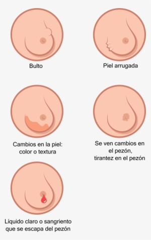 Breast Cancer Illustration Es - Breast Cancer #4206697