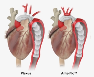 It Is Designed For Intuitive And Accurate Deployment, - Frozen Elephant Trunk Graft #4275480