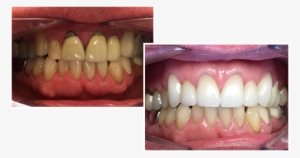 Here At 3d Dental Laboratories We Offer Only The Highest - Tongue #4275928