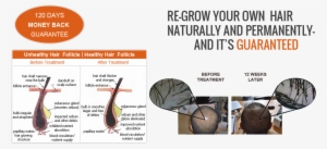 Laser Hair Loss Treatment Therapy - Laser Hair Therapy #4276721