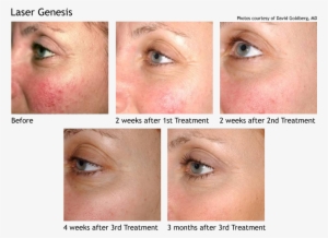 Laser Genesis Skin Therapy - Laser Genesis #4277074