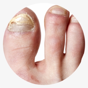 Nail Infection Circle - Natural Way To Get Rid Of Toenail Fungus #4319705