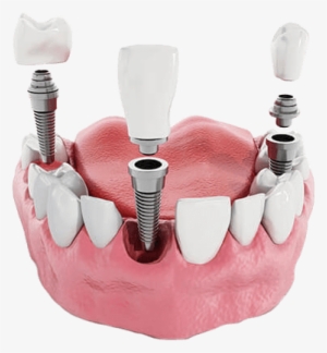 Port Jefferson Smiles Karen Halpern Dmd, Ms Dental - Impianto Dentale Straumann #4414194