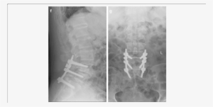 F, G Postoperative Lumbar Spine Showing L4-l5 Correction - Lumbar Vertebrae #4432306
