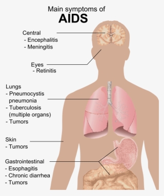 Symptoms Of Aids #4492379