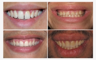 A Standardized Smiling Frontal Photograph Was Taken #4530123