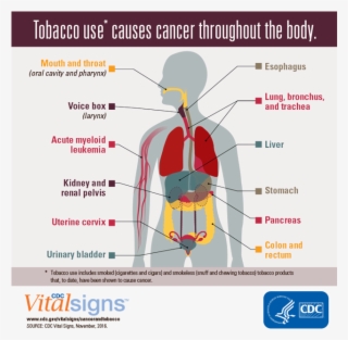 Cancer Caused By Tobacco Consumption #4545995