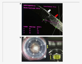 The White Arrow Indicates The Corneal Graft - Capsulotomy #4561929