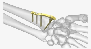 Divergent Radial Styloid Plate - Radial Styloid Plate #4632120