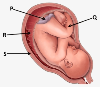 Image Showing Pregnancy - Placenta Previa #4673290