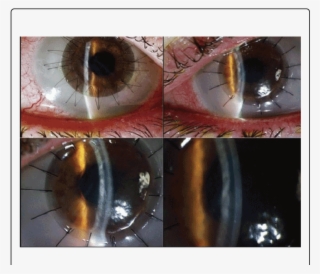 Post Dalk Images (sibling 1) Of Right And Left Corneas - Cornea #4692659