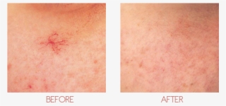 About - Facial Vein #4728219