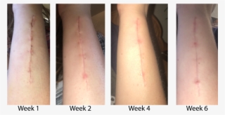 Mary's Cbc Compound Scar Progression - Scar Progression #4746650