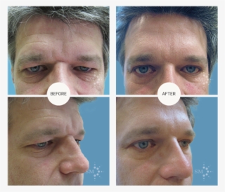 Forehead Lift - Montreal #4789998