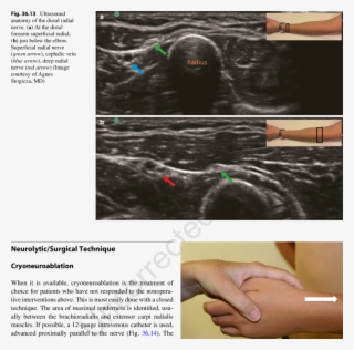 14 Direction Of The Cryoprobe For Cryoneuroablation - Superficial Radial Nerve Ultrasound #4878765