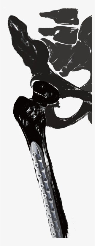 0mm Screw System In Femur A - Illustration #4897325