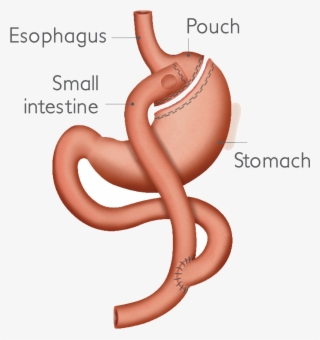 Laparoscopic Roux En Y Gastric Bypass #4911883