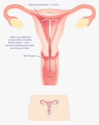 You - Copper T Family Planning Method #4912771