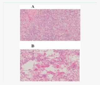 Histologic Assessment Of Post Mortem Lung Tissue - Staining #4954047