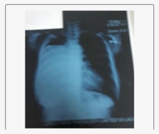 Chest X-ray At Presentation #4990184