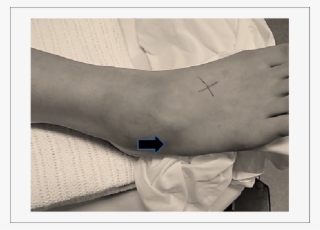 Arrow Pointer At Area Where There Is Tenderness And - Arrow #4999647