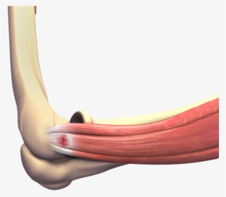 Tennis Elbow - Tennis Elbow Surgery #5076964