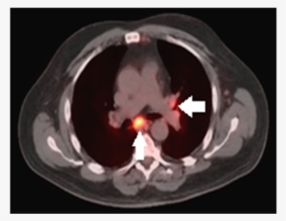Pet/ct Of Head/thorax - Mediastinal Lymph Node #5090223