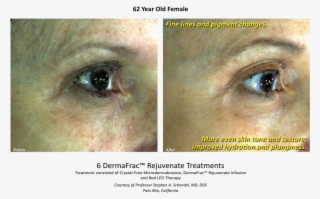 Va Before & After Dermafrac Skin Rejuvenation Injections - Dermafrac Before And After #5113182