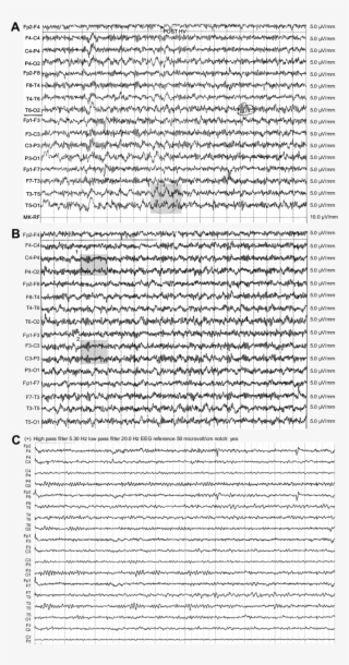 First Eeg Pattern Of The Patient - Delta Wave #5152127