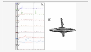 Preoperative Esophageal Manometry Findings - Sketch #5152357