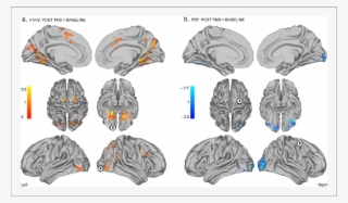 Distinct Effects Of Local Inhibitory Tms Over Early - Occipital Pole #5215825