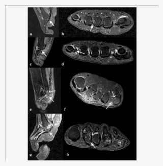Intermediate Weighted, Fat Suppressed Sagittal And - Fat #5231027
