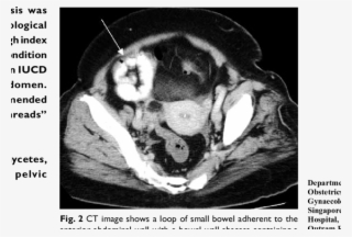 Ct Image Shows Inflammatory Stranding Of Fat And A - Pelvic Ct That Shows An Ovarian Mass #5231742