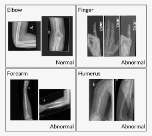 Aprendizaje Profundo Y Rayos X - X-ray #535086