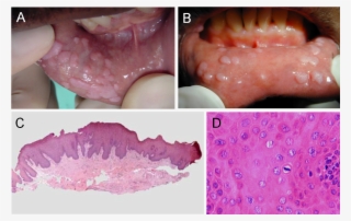 Figure 4 - - Difference Squamous Cell Papilloma Condyloma #5391734