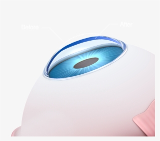 Conductive Keratoplasty #5398200