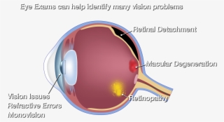 Eyeball Chart - Age Related Macular Degeneration - Free Transparent PNG ...