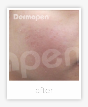 Dermapen Acne Scars - Dermapen Before After #552891
