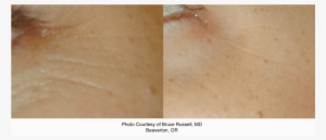 Laser Genesis - Close-up #553026