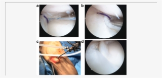 Intra Operative Images Showing The Final Repair - Television Show #5595310