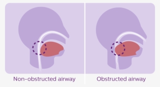 Sleep Apnea Diagram - Sleep Apnea #5646643