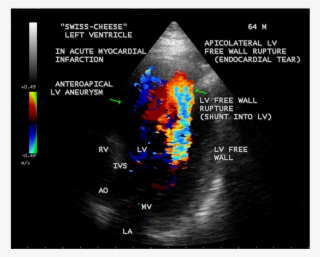 Apical 3 Chamber View Showing The Apicolateral Lv Free - Ventricular Free Wall Rupture Echo #5670158