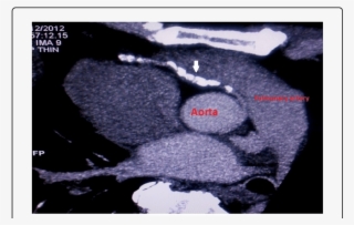 Gd-enhanced Ct Angio With Mip Image Showing Anomalous #5680508