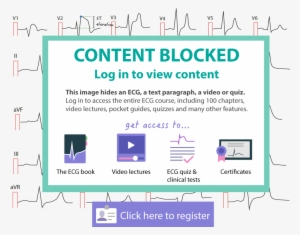 The Ecg Leads Includes The Limb Leads And The Chest - Cardiac Stress Test #574342
