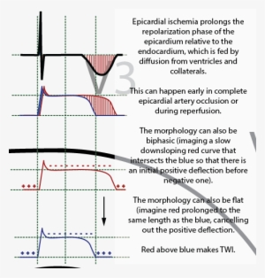 Spontaneous Reperfusion Or Decreasing Demand On The - Diagram #575138